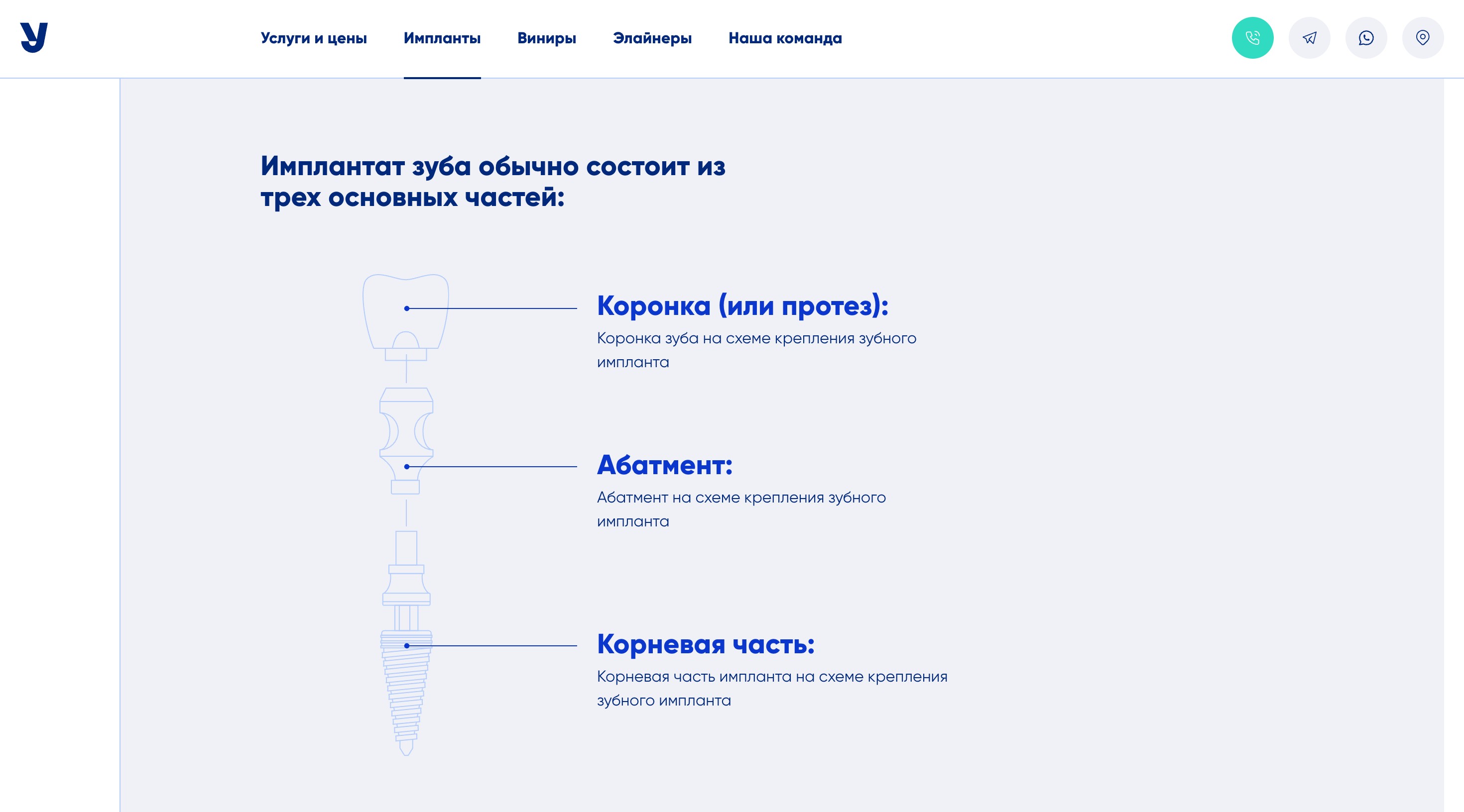 Дизайн сайта стоматологии, страница об имплантах, схематическое изображение импланта с указанием его составных частей
